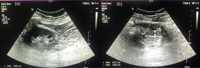 Perirenal Fat Volume Is Positively Associated With Serum Uric Acid Levels in Chinese Adults